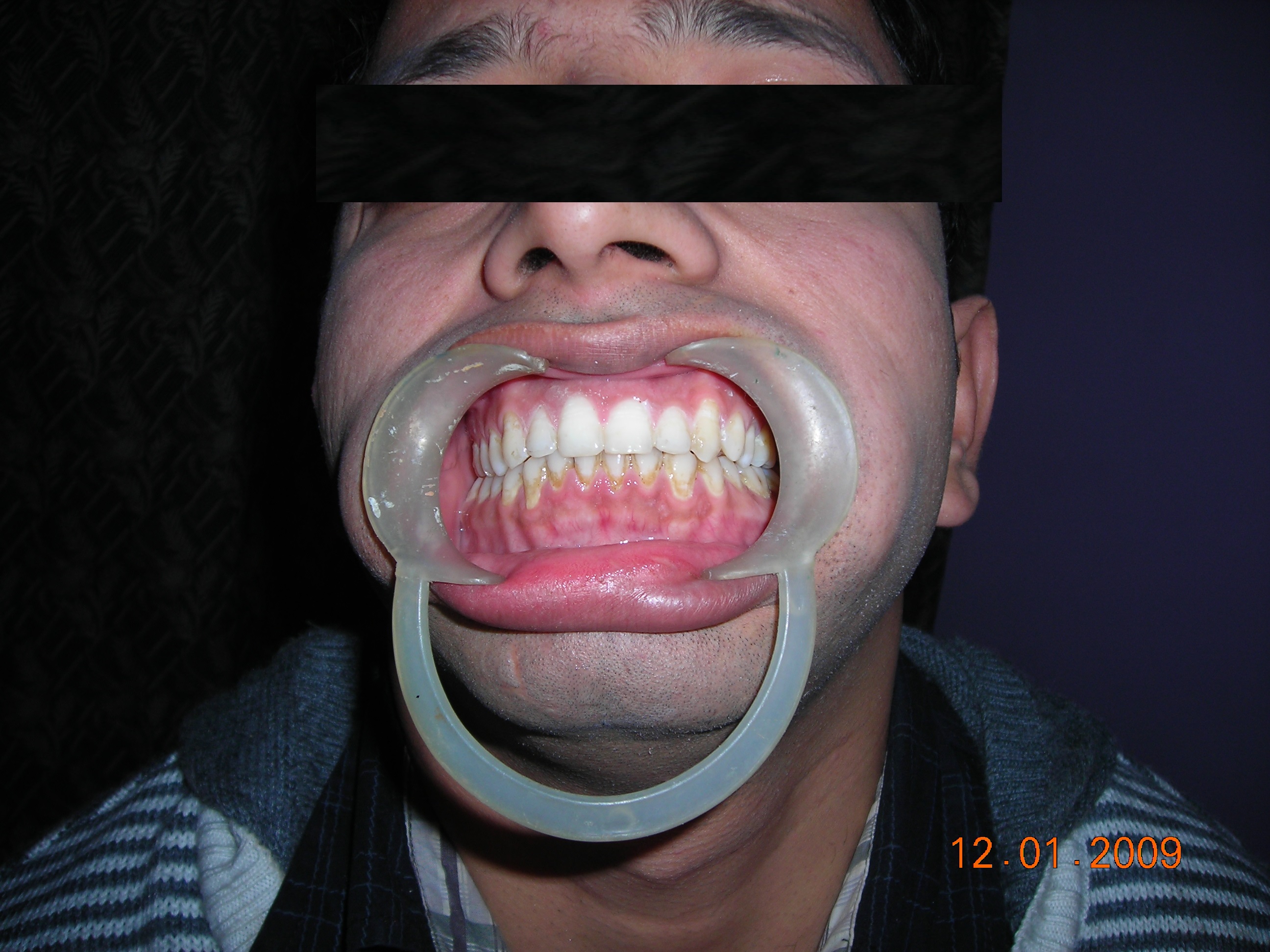 Missing Teeth Predict Strokes