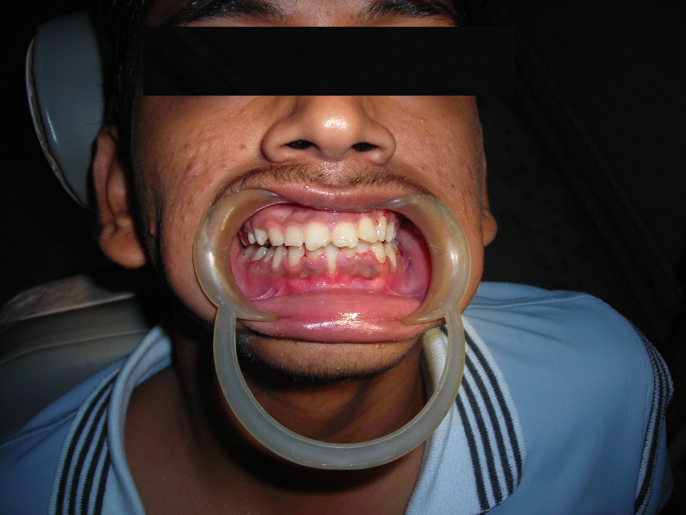 Missing Teeth Predict Strokes