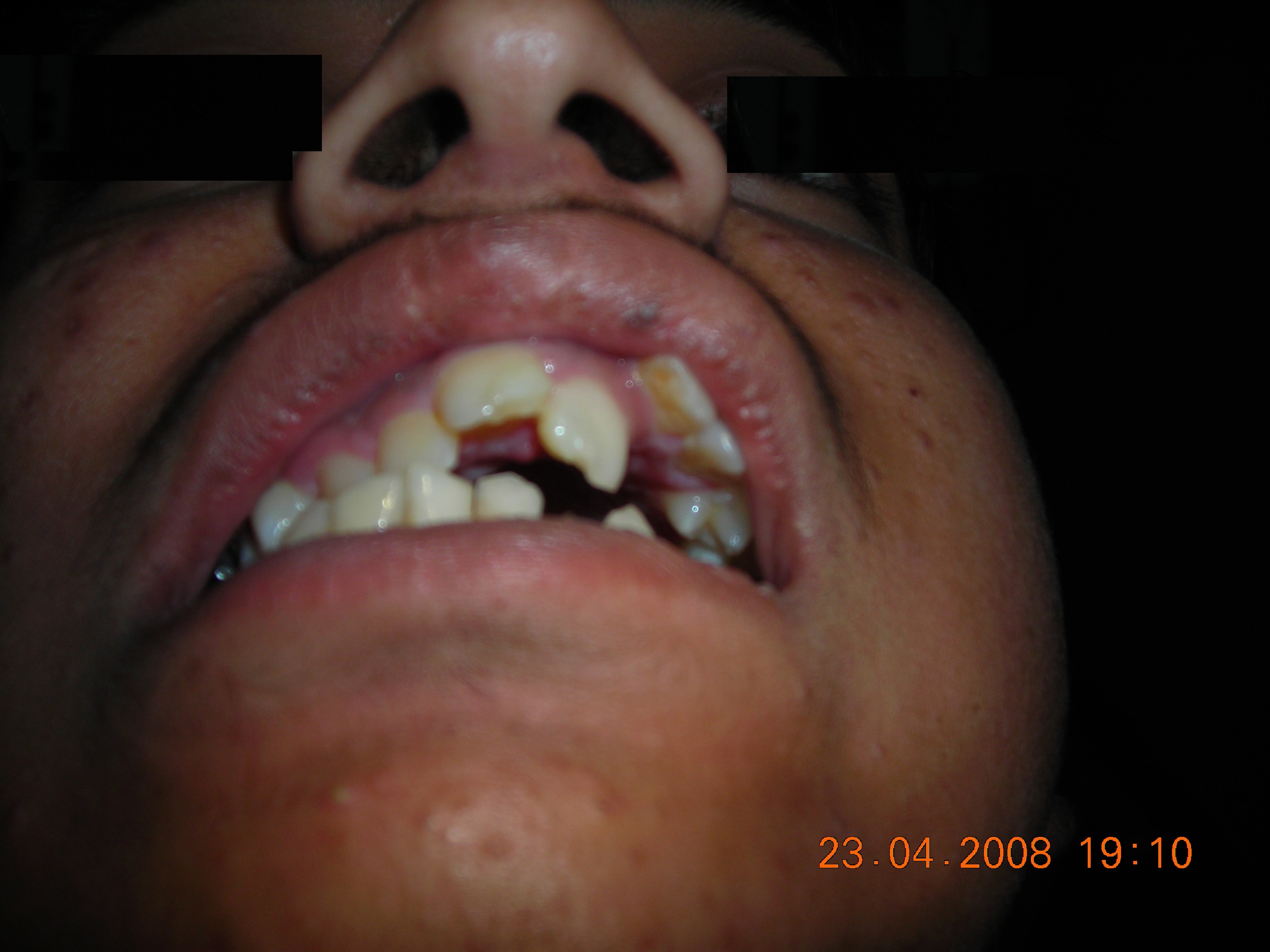 Missing Teeth Predict Strokes