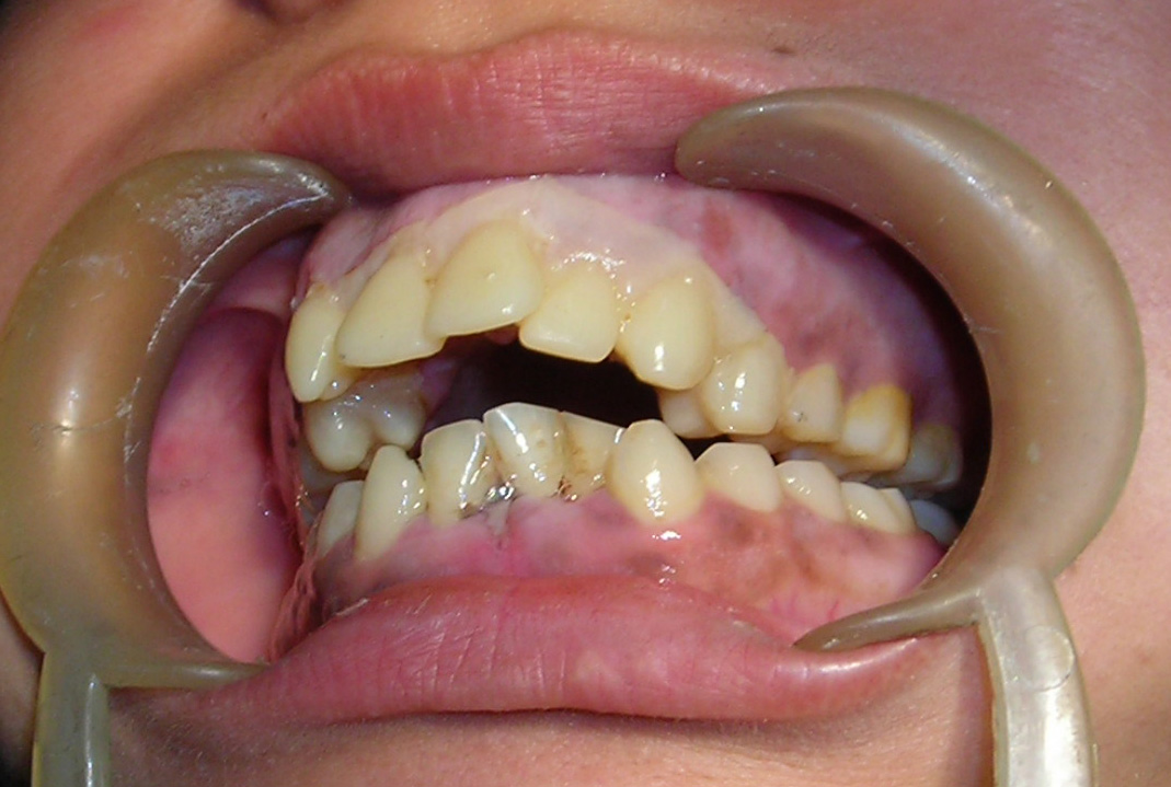 Missing Teeth Predict Strokes