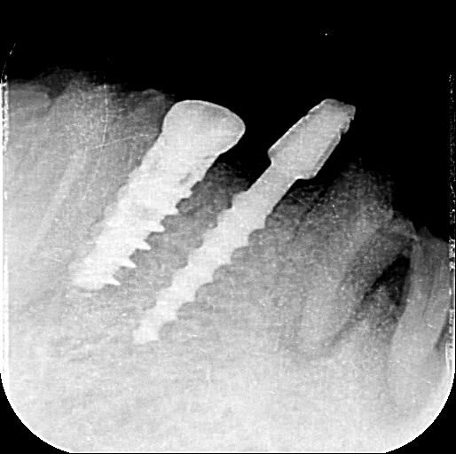 Missing Teeth Predict Strokes