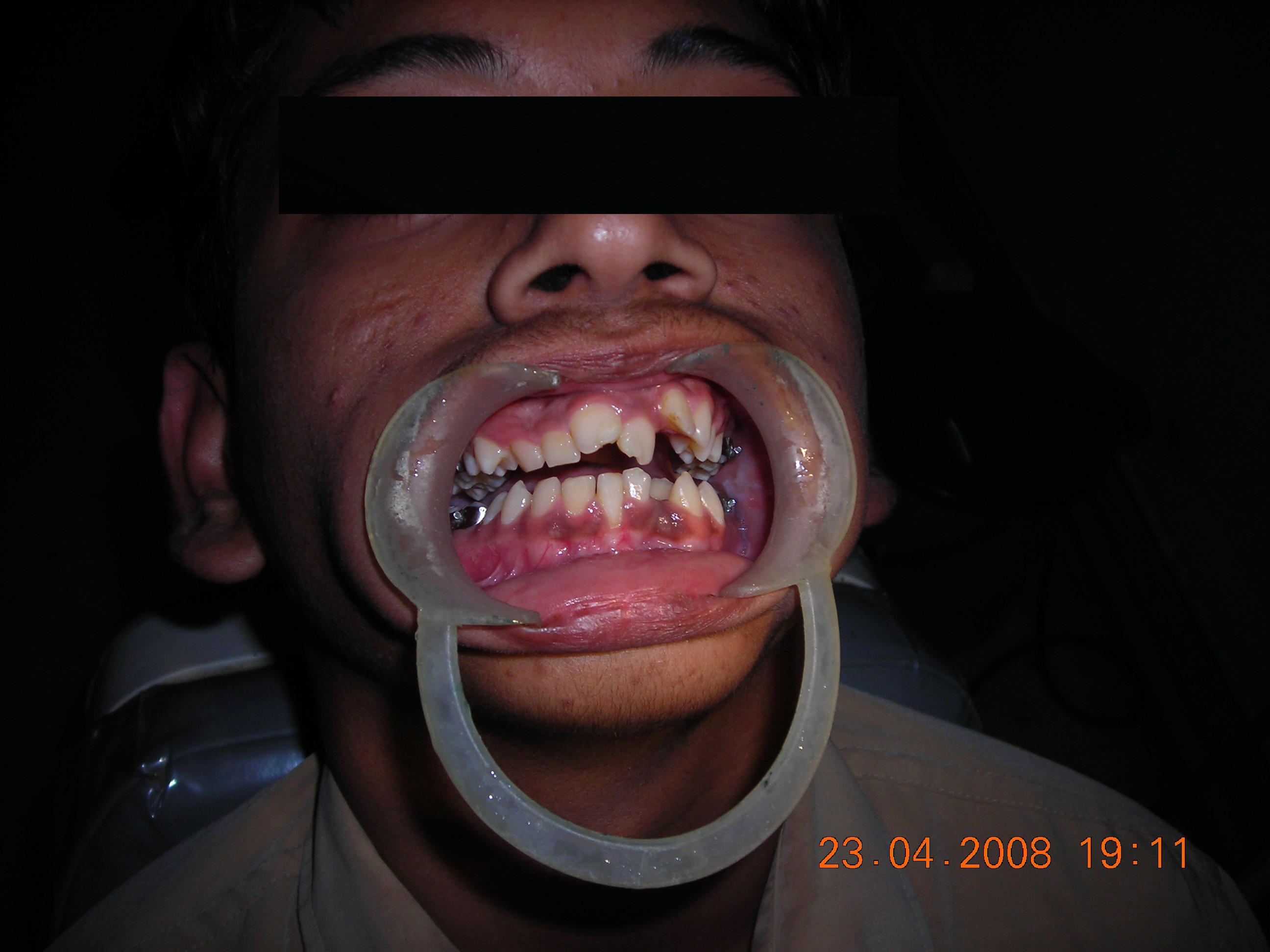 Missing Teeth Predict Strokes