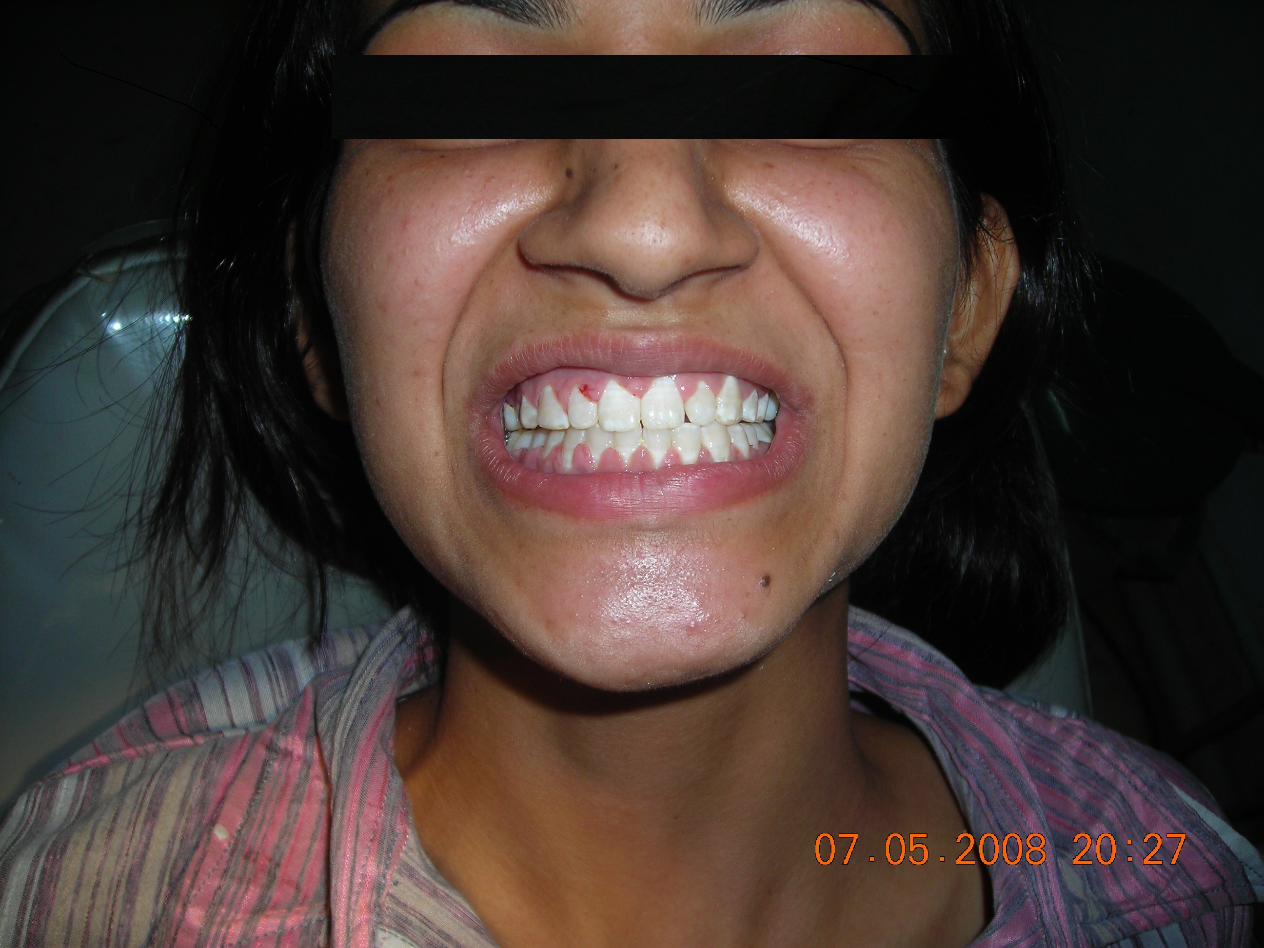 Missing Teeth Predict Strokes