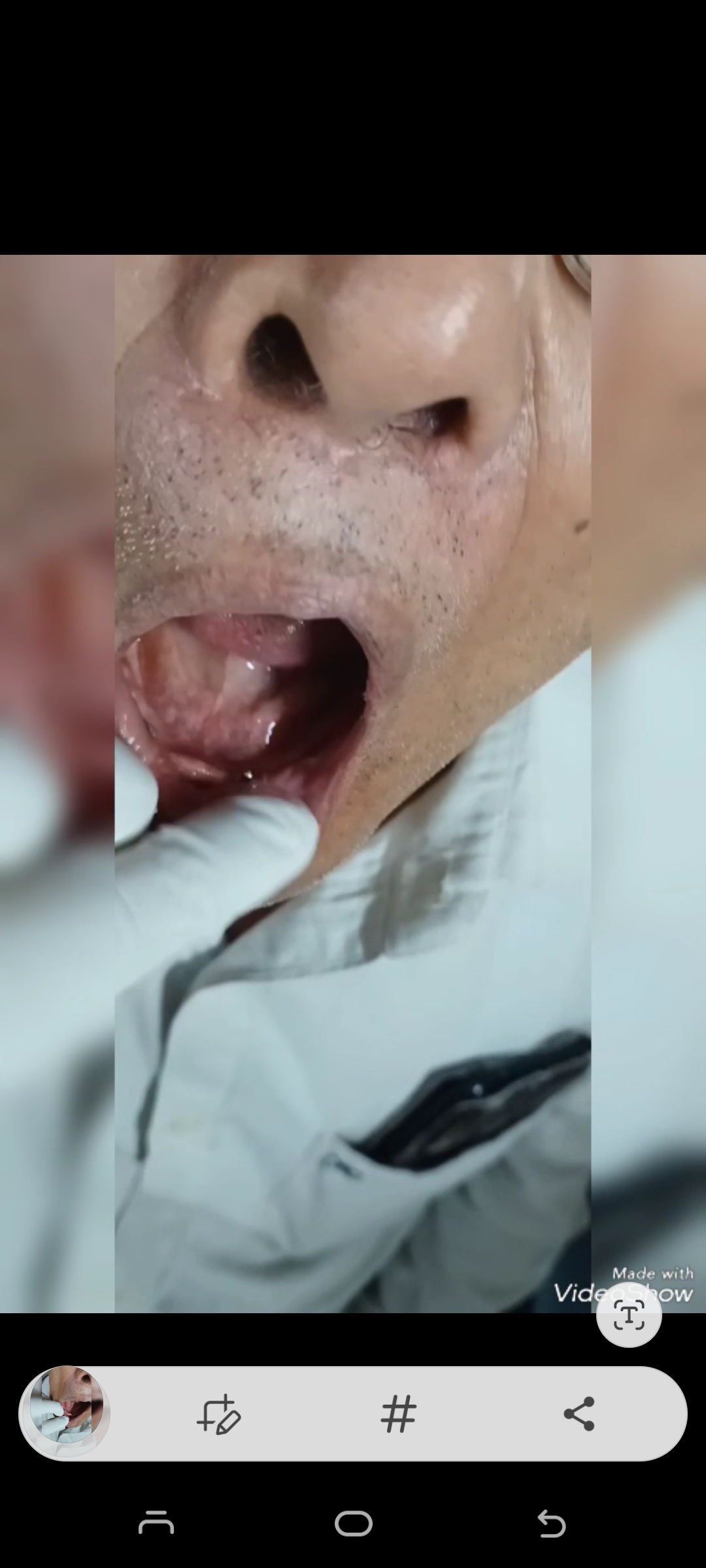 Missing Teeth Predict Strokes