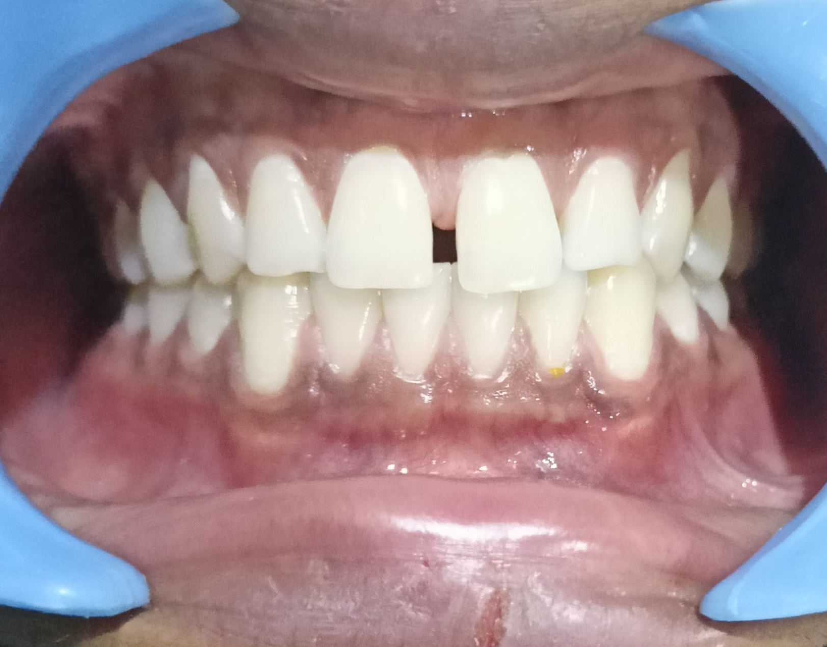 Missing Teeth Predict Strokes