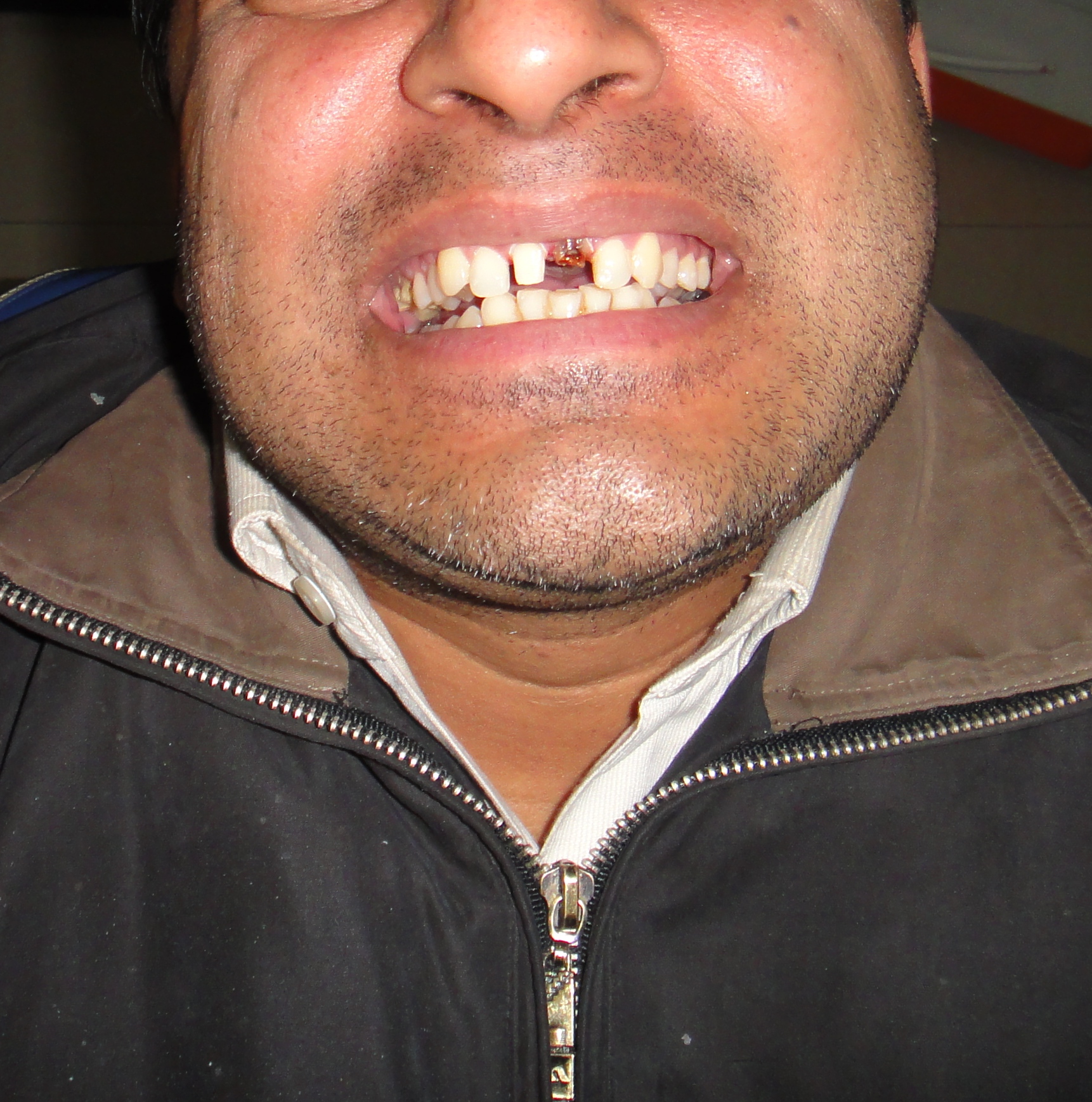 Missing Teeth Predict Strokes