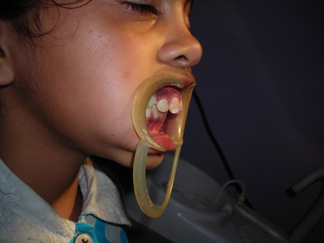 Missing Teeth Predict Strokes