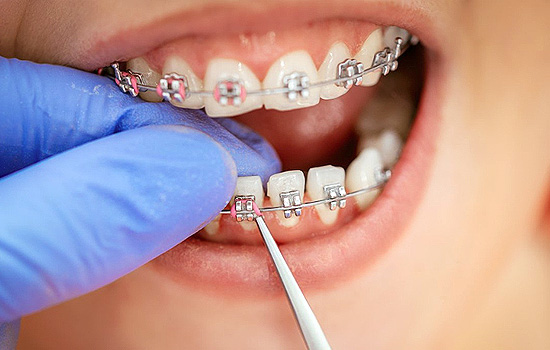 Braces & Orthodontics — representative treatment image