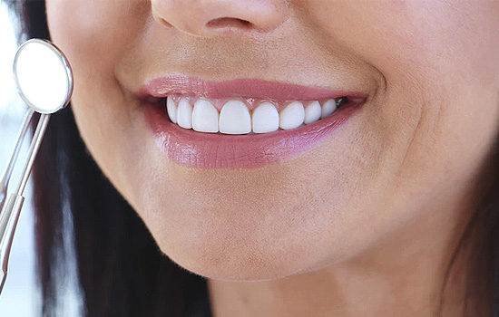 Teeth Whitening — representative treatment image